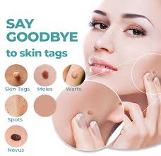 Tags & Moles Remover (BUY 1 GET 1 FREE)